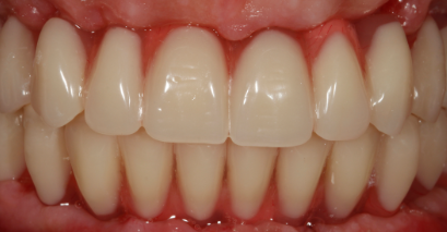 Тотальная имплантация «Все-на-6» с дистанционной консультацией