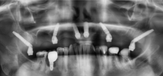 Тотальная имплантация верхней челюсти с установкой птеригоидных имплантов