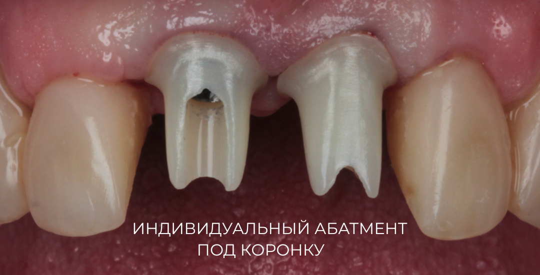 Восстановление центральных резцов циркониевыми коронками