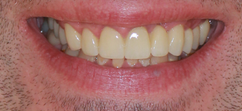 Восстановление эстетики улыбки