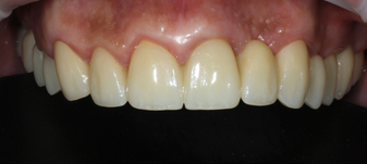 Восстановление эстетики улыбки