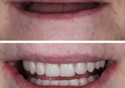 Восстановление зубов в Минске: современные методы, этапы и стоимость