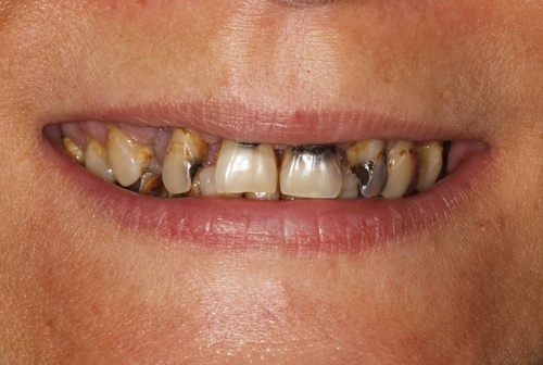 All-ON-6 - от временного до постоянного протеза