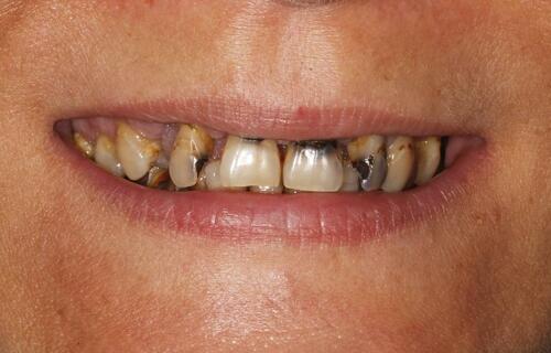 All-ON-6 - от временного до постоянного протеза