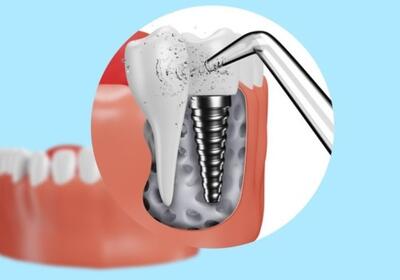 Особенности ухода за зубными имплантами