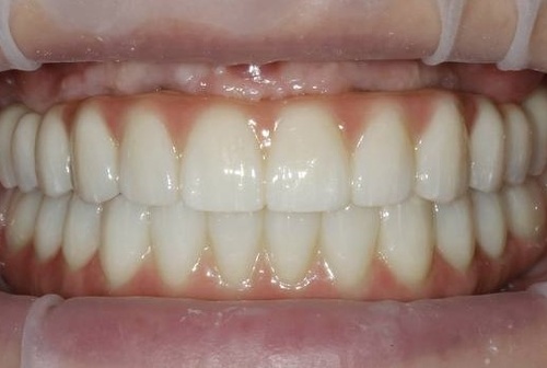 All-ON-6 - от временного до постоянного протеза