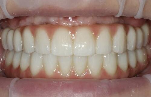 All-ON-6 - от временного до постоянного протеза