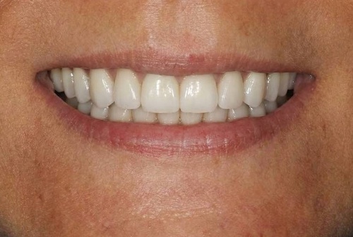 All-ON-6 - от временного до постоянного протеза