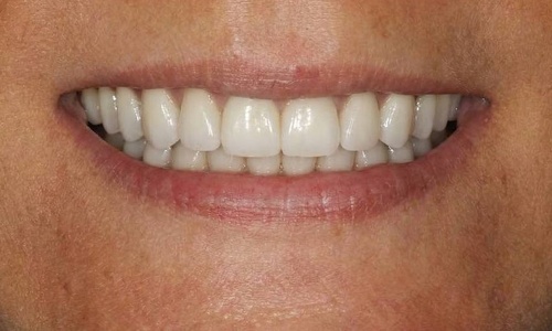 All-ON-6 - от временного до постоянного протеза