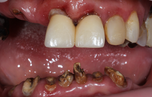 ALL-ON-4 с металлокерамическим протезом