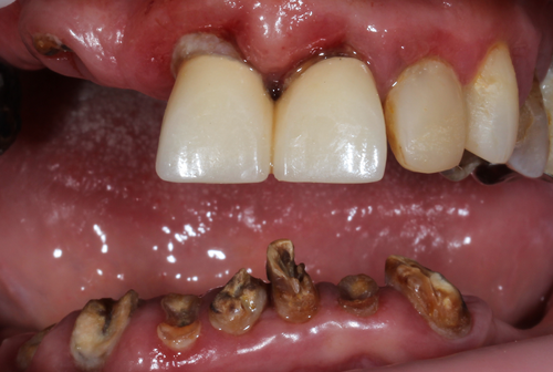 ALL-ON-4 с металлокерамическим протезом