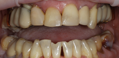 Тотальная имплантация верхней челюсти с установкой птеригоидных имплантов