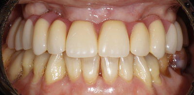 Тотальная имплантация верхней челюсти с установкой птеригоидных имплантов