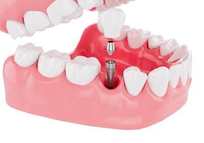 Методики имплантации зубов
