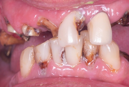 Восстановление улыбки за короткие сроки