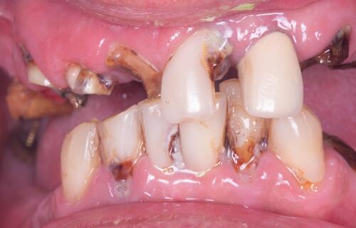 Восстановление улыбки за короткие сроки