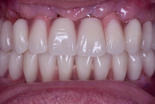 Восстановление улыбки за короткие сроки