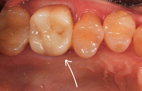 Замена временной коронки на циркониевую. Протезирование на собственном зубе