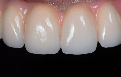 ALL-ON-4 с металлокерамическим протезом