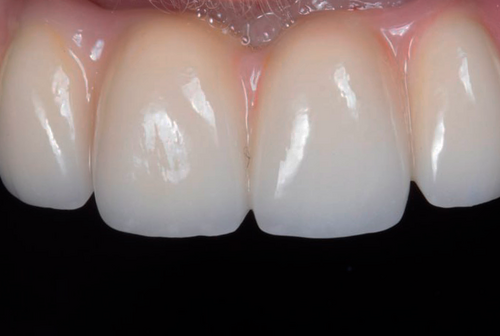 ALL-ON-4 с металлокерамическим протезом