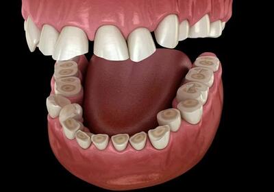 Бруксизм - что это? Методики лечения бруксизма