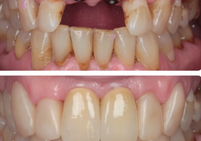 Особенности имплантации передних зубов