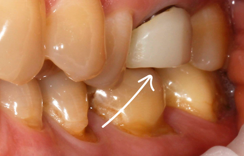 Замена временной коронки на циркониевую. Протезирование на собственном зубе