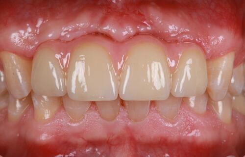 Протезирование фронтальных зубов на имплантах