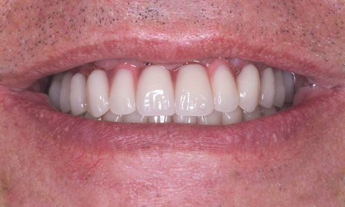 Восстановление улыбки за короткие сроки