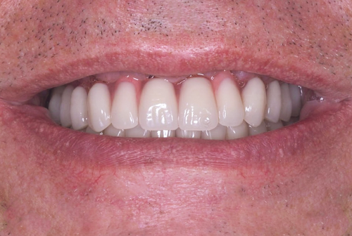 Восстановление улыбки за короткие сроки