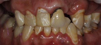 Восстановление эстетики улыбки