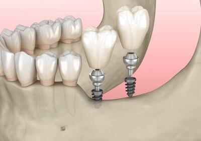 Рекомендации после имплантации зубов