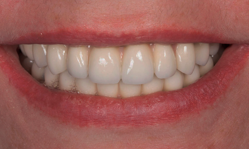 ALL-ON-4 с металлокерамическим протезом