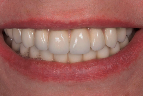 ALL-ON-4 с металлокерамическим протезом