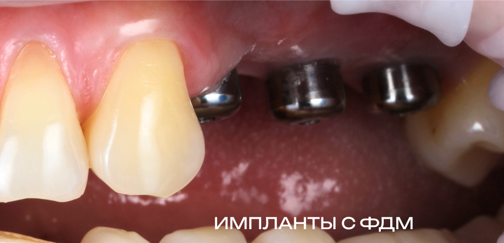 Циркониевые коронки на имплантаты