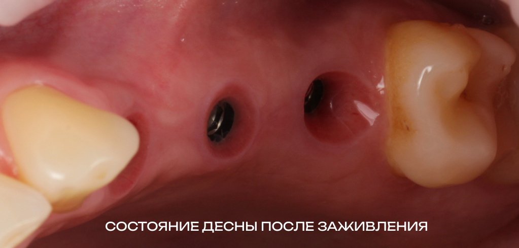 Циркониевые коронки на имплантаты