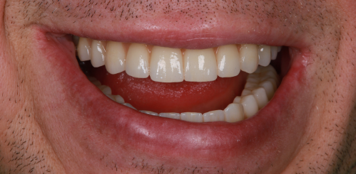 Полное восстановление зубов при периодонтите