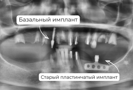 Постоянное протезирование ALL-ON-6 - металлокерамический протез