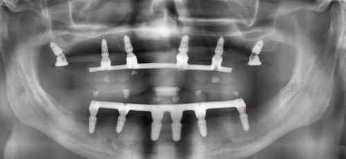 Полное восстановление зубов при периодонтите