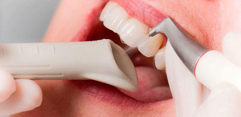 Air Flow Teeth Cleaning