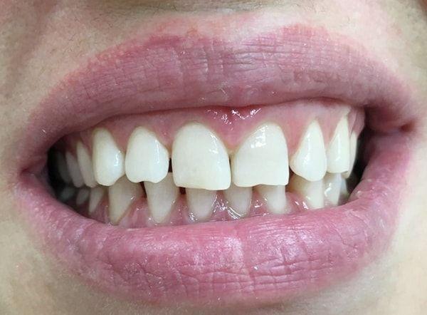Фторирование - защита зубов от кариеса