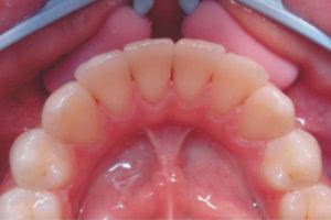 удаление зубного камня ультразвуком