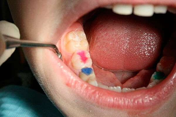 Treatment of dental caries in children