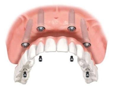 Typy implantów dentystycznych