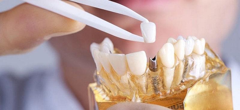 Классическая двухэтапная имплантация зубов