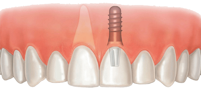 Implantation front teeth