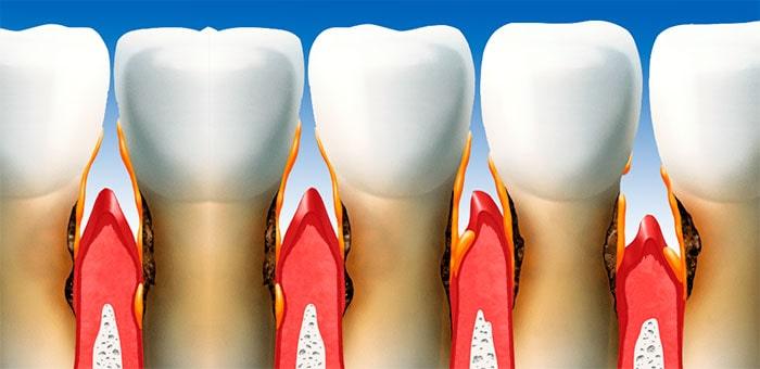 Zahnimplantate für Parodontitis und Parodontitis