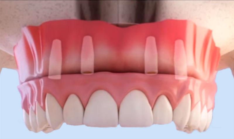 Имплантация зубов по протоколу all-on-four