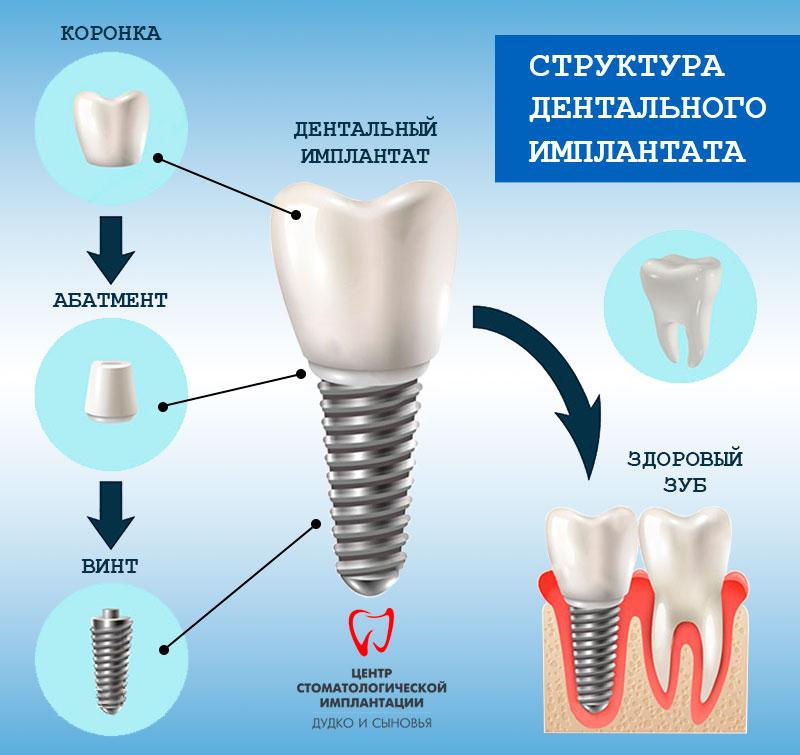 Die Struktur eines künstlichen Zahns besteht aus: einem Implantat, das die Zahnwurzel ersetzt, einem Abutment, das als Befestigung für die Krone dient. Die Krone erzeugt eine Imitation eines echten Zahns.