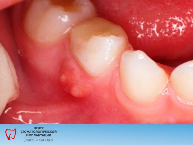 Parodontitis bei Kindern